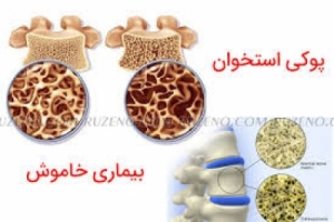 پوکی استخوان