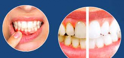 نشانه ها و علائم مورد  استفاده در جداول دندان